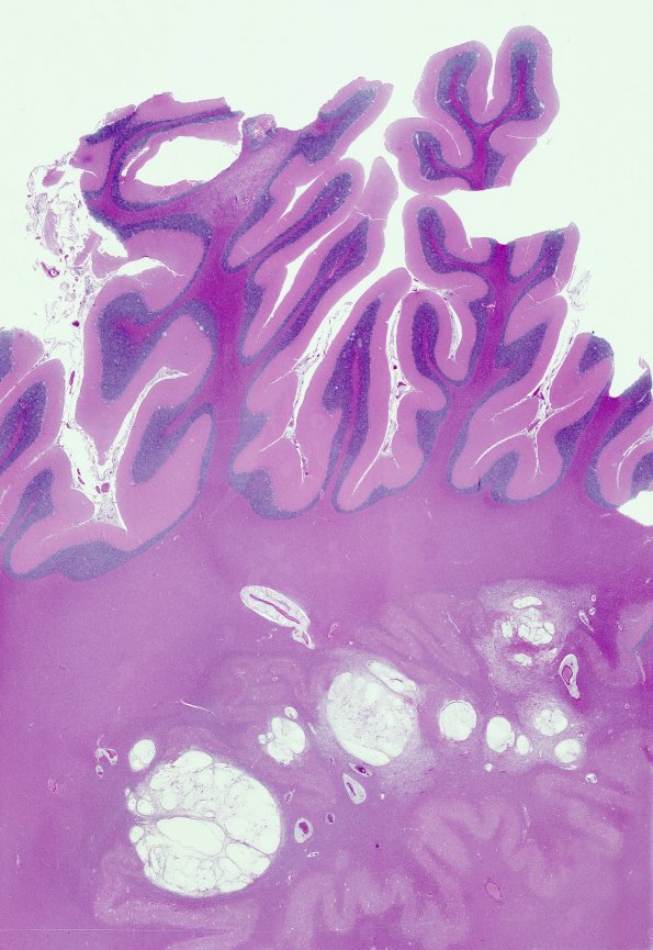 4B1 Cryptococcus (Case 4) Cbell