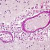 4B2 Cryptococcus (Case 4) PAS A