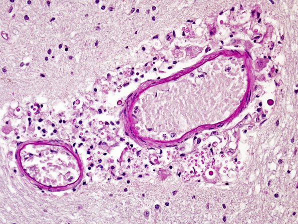 4B2 Cryptococcus (Case 4) PAS A