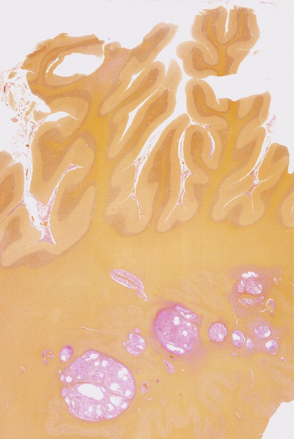 4C1 Cryptococcus (Case 4) Mucin Whole mount