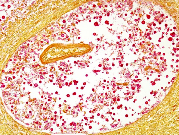 4C2 Cryptococcus (Case 4) Mucin 1