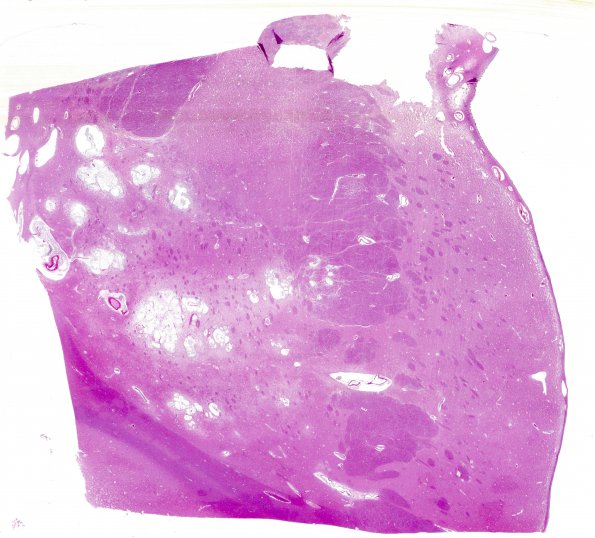 5C1 Cryptococcus (Case 5) N2 H&E whole mount