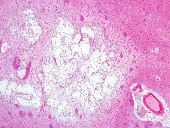 5C2 Cryptococcus (Case 5) N2 H&E 4