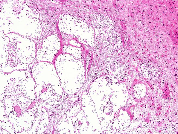 5C3 Cryptococcus (Case 5) N2 H&E 5