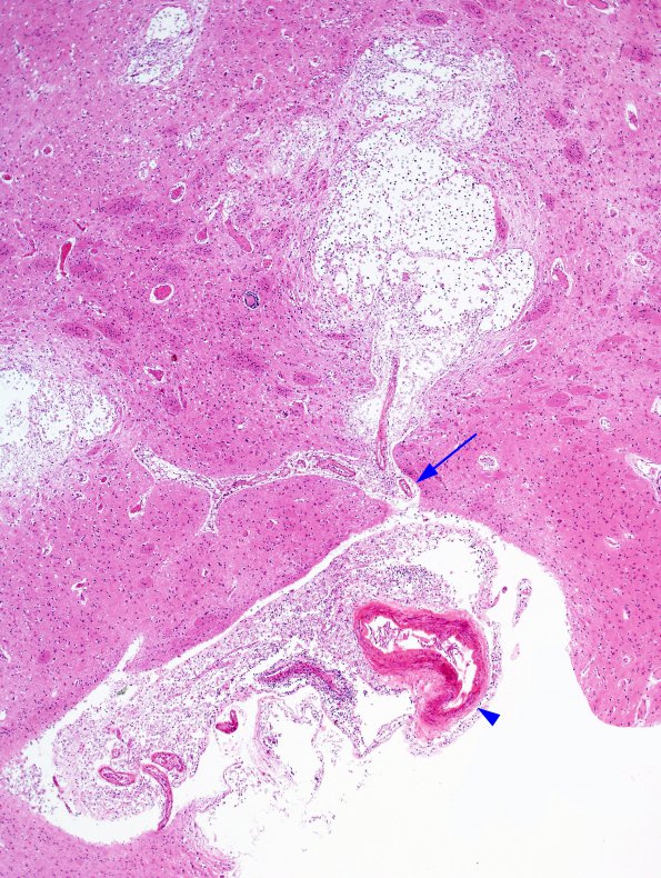 5C4 Cryptococcus (Case 5) N2 H&E 6 copy