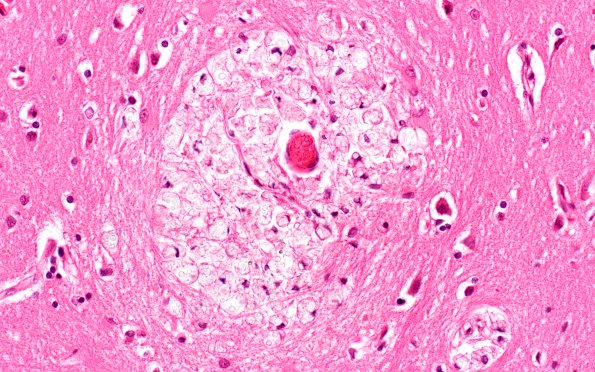 7B1 Cryptococcus (Case 7) N3 H&E 40X