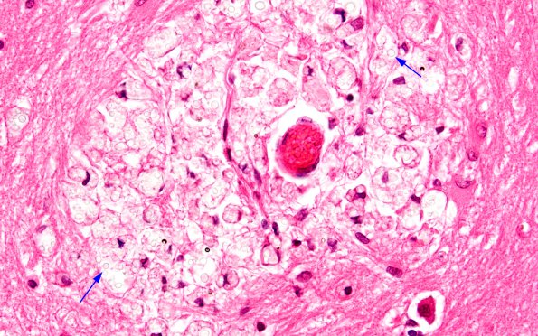 7B2 Cryptococcus (Case 7) N3 H&E 60X copy