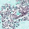 7C1 Cryptococcus (Case 7) N3 GMS 40X