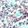 7C2 Cryptococcus (Case 7) N3 GMS 60X