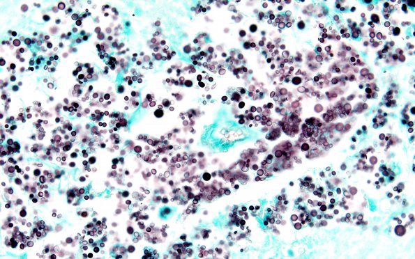 7C2 Cryptococcus (Case 7) N3 GMS 60X