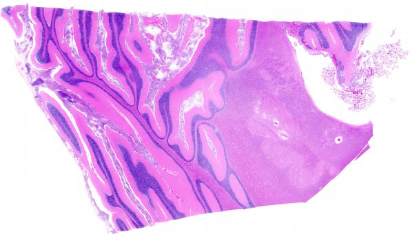 8A1 Cryptococcus (Case 8) H&E whole mount