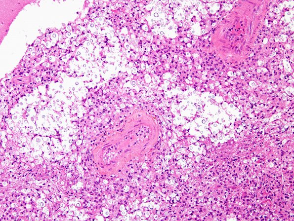 8A2 Cryptococcus (Case 8) H&E 3