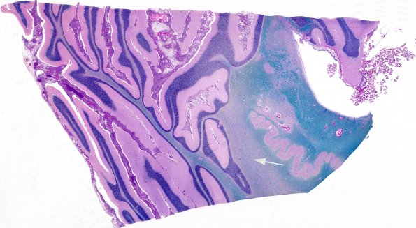 8B1 Cryptococcus (Case 8) LFB-PAS whole mount copy