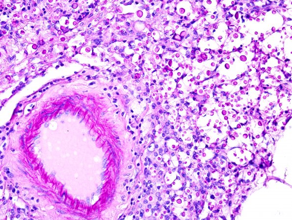 8B2 Cryptococcus (Case 8) LFB-PAS 3