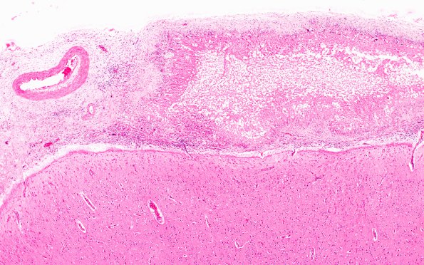 9B3 Cryptococcus (Case 9) H&E 4X