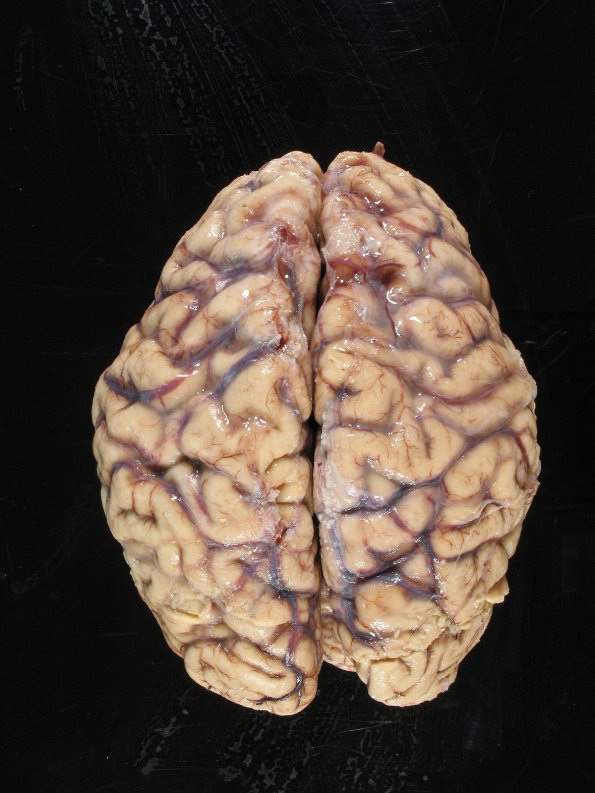 1A1 Cryptococcoma (Case 1) 2