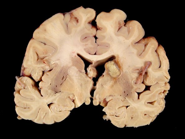 1A2 Cryptococcoma (Case 1) 3