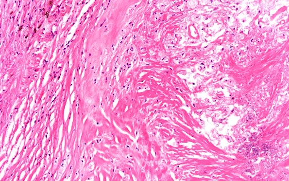 1B2 Cryptococcoma (Case 1) H&E 2