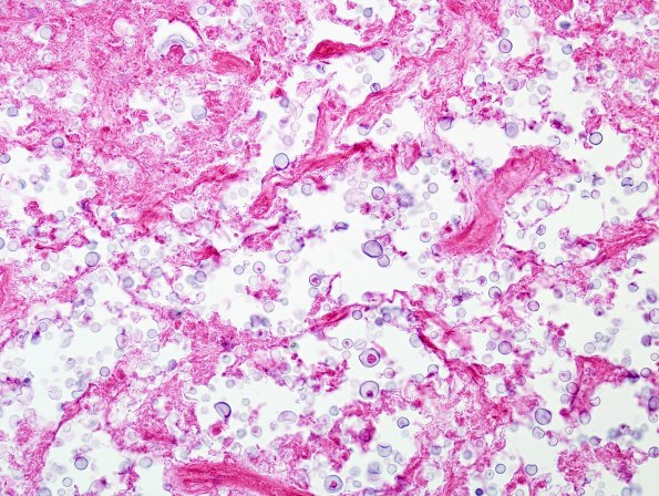 1B3 Cryptococcoma (Case 1) H&E 2