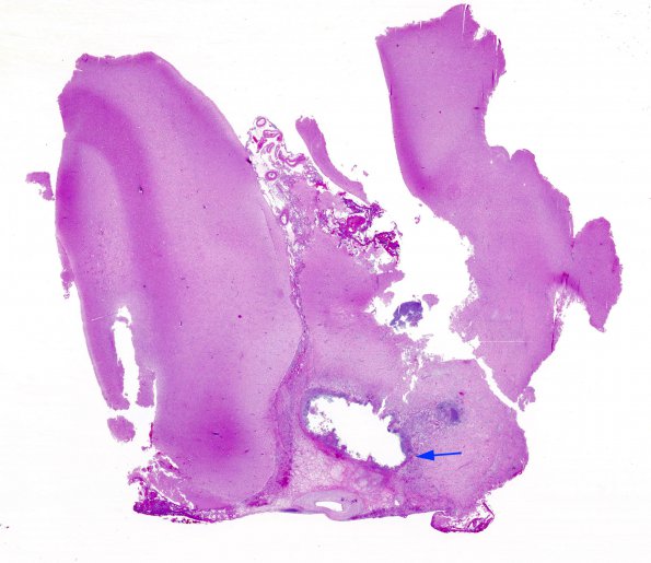 2A1 Cryptococcoma (Case 2) H&E whole mount copy