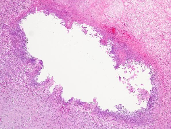 2A2 Cryptococcoma (Case 2) H&E 4