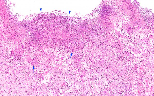 2A3 Cryptococcoma (Case 2) H&E 4 copy