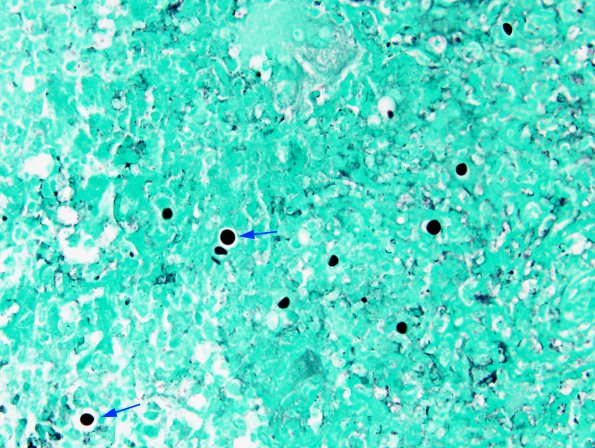 2B1 Cryptococcoma (Case 2) GMS copy