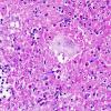 2B2 Cryptococcoma (Case 2) PAS copy