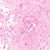 2B4 Cryptococcoma (Case 2) Alcian-Blue 1 copy