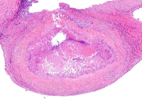 3A1 Cryptococcoma (Case 3) H&E 4
