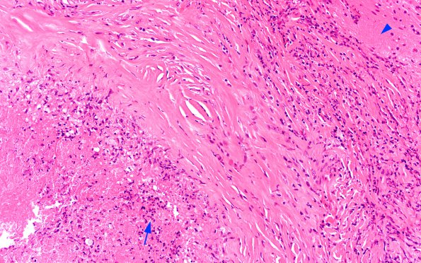 3A2 Cryptococcoma (Case 3) H&E 2C copy