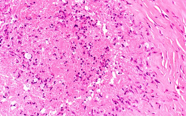 3A3 Cryptococcoma (Case 3) H&E 2B