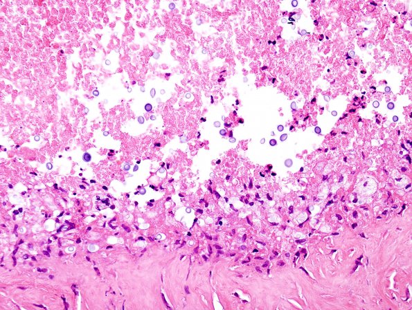 3A4 Cryptococcoma (Case 3) H&E 2