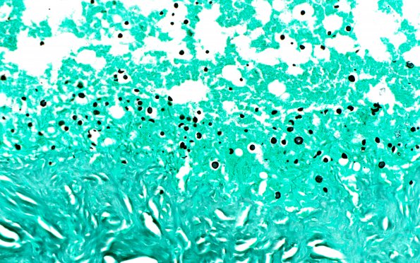 3B1 Cryptococcoma (Case 3) H&E 4