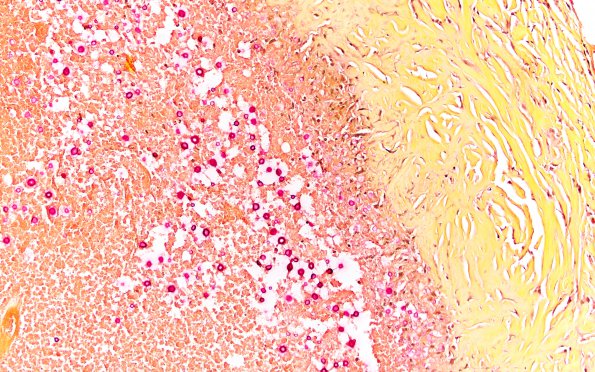 3B2 Cryptococcoma (Case 3) Mucicarmine 4A