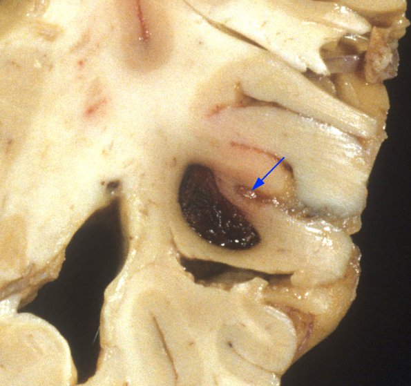 1A3 Cryptococcus (Case 1) mycotic aneurysm 2A field copy