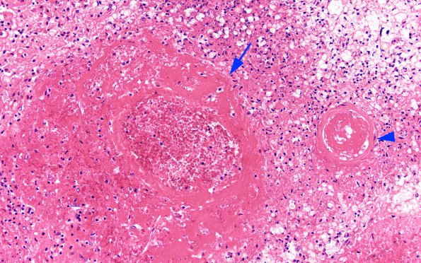 1B3 Mycotic aneurysm (Case 1) H&E 4 copy