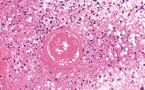 1C2 Mycotic aneurysm (Case 1) H&E 5A