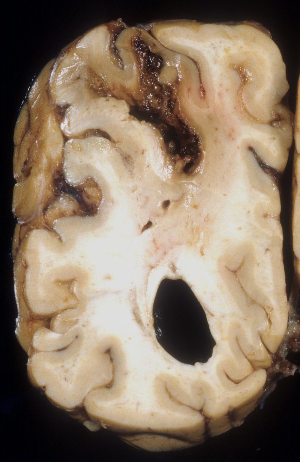 1D2 Cryptococcus, mycotic aneurysm (Case 1) Gross 4