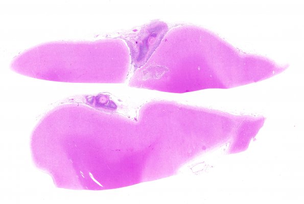 1B1 Cryptococcus (Case 1) H&E H whole mount