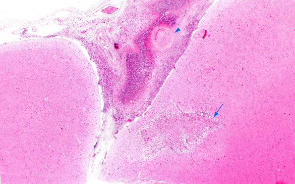 1B2 Cryptococcus (Case 1) H&E H 4X copy