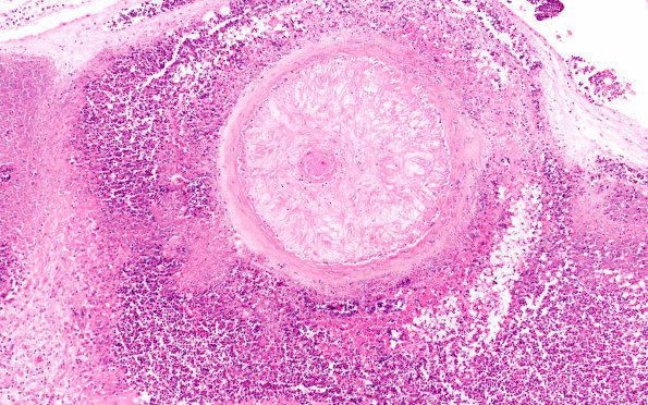 1B3 Cryptococcus (Case 1) H&E H 10X