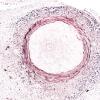 1C3 Cryptococcus (Case 1) GMS H 10X