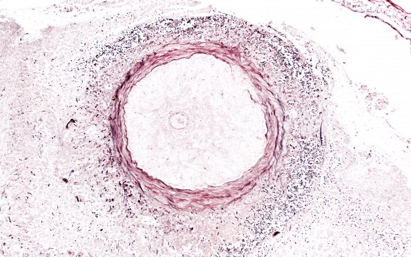 1C3 Cryptococcus (Case 1) GMS H 10X