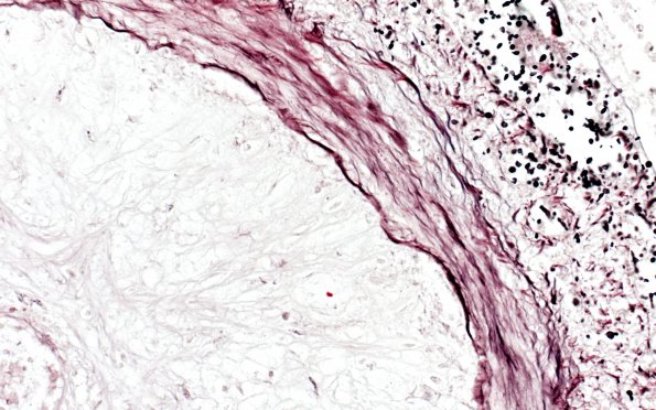 1C4 Cryptococcus (Case 1) GMS H 40X