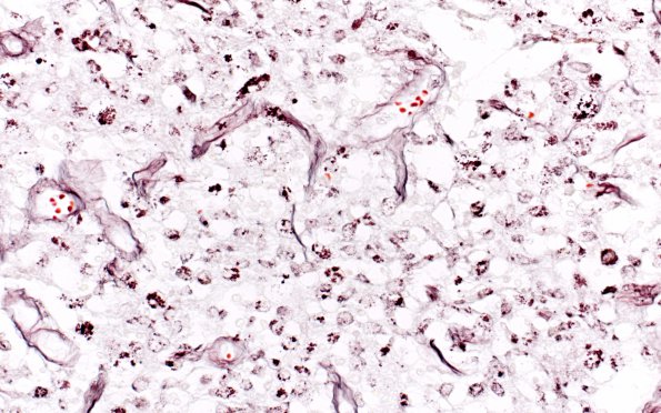 1C5 Cryptococcus (Case 1) GMS H infarct center 40X 2