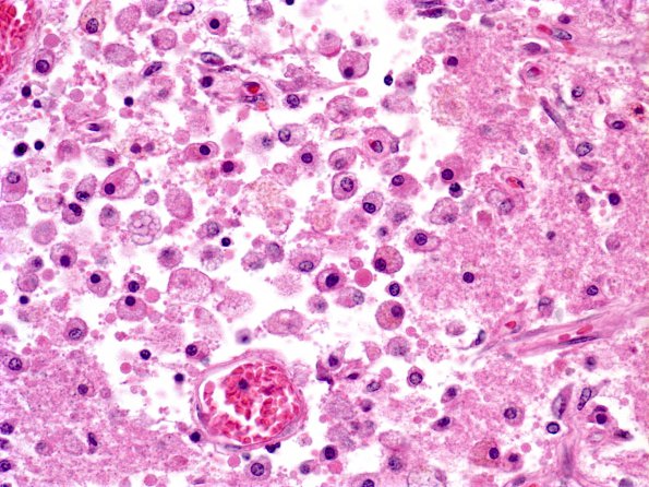 1E3 Cryptococcus (Case 1) H&E 3