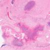 1E4 Cryptococcus (Case 1) H&E 1A