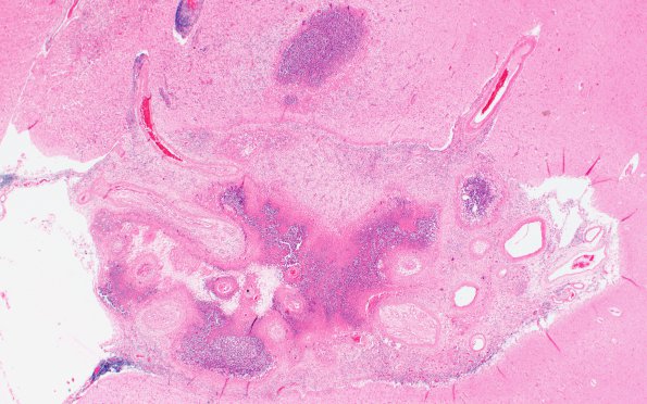 1E4 Cryptococcus (Case 1) H&E 1A