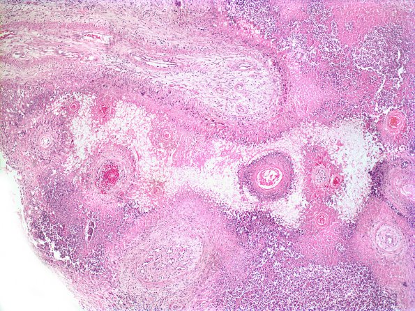 1E5 Cryptococcus (Case 1) H&E 5A